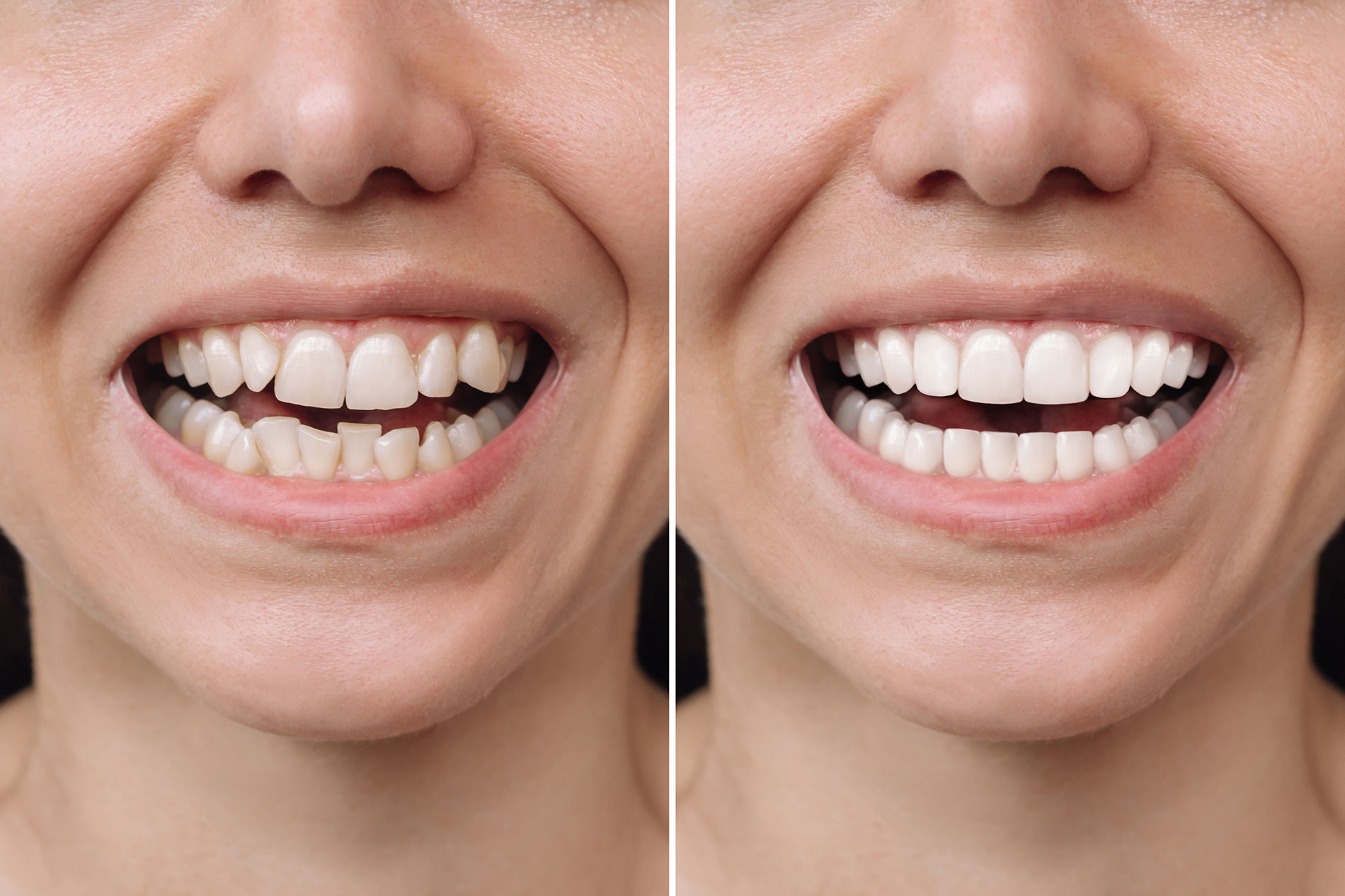 Dental Implants